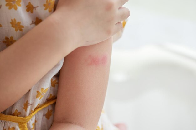 Photo little girl has skin rash allergy itching and scratching on her arm