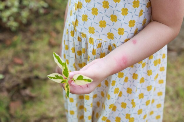 Photo little girl has skin rash allergy itching and scratching on her arm