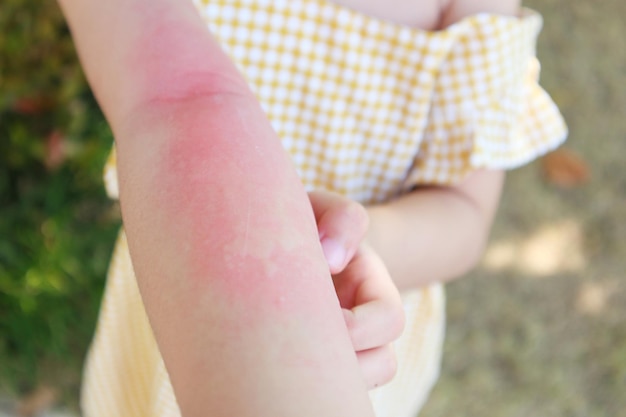 Little girl has skin rash allergy and itchy on her arm