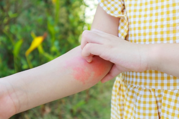 Little girl has skin rash allergy and itchy on her arm