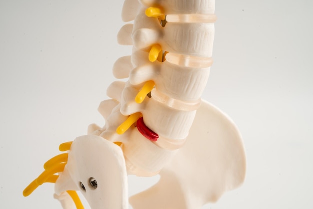 Lumbar spine displaced herniated disc fragment spinal nerve and bone Model for treatment medical in the orthopedic department