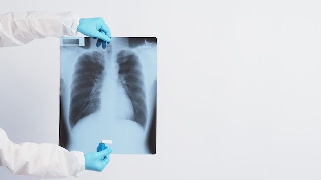 Lungs x-ray film in doctor hands wearing medical gloves and PPE suit which showing scan-film of uncommon respiratory syndrome or pneumonia disease or unhealthy-lung that infected by Coronavirus