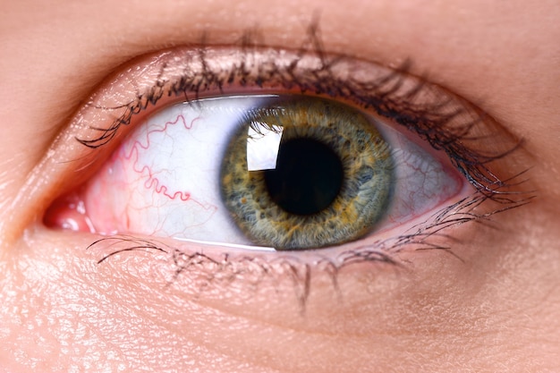 Macro photo of an eye with a yellow-gray iris and capillaries