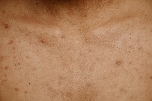 Photo macro shot of tan skin with acne scar spots and texture