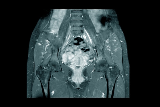 Magnetic Resonance Imaging Pelvic of a Healthy Woman finding Abnormalities like mass lumps.Medical healthcare concept.