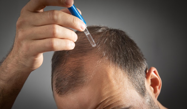 Man applying dropper vitamin on head Baldness treatment concept