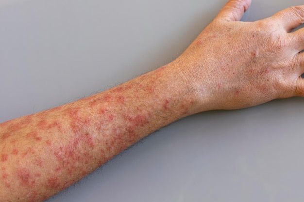 Man's arm with herpes virus skin patches