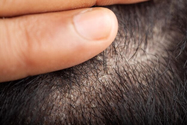 Photo man showing his hair scalp