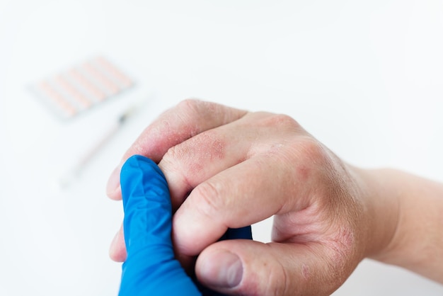 A man shows a reddened rash on his hands to the doctor Causes of itchy skin can be dermatitis eczema dry skin burns food allergies healthcare concept