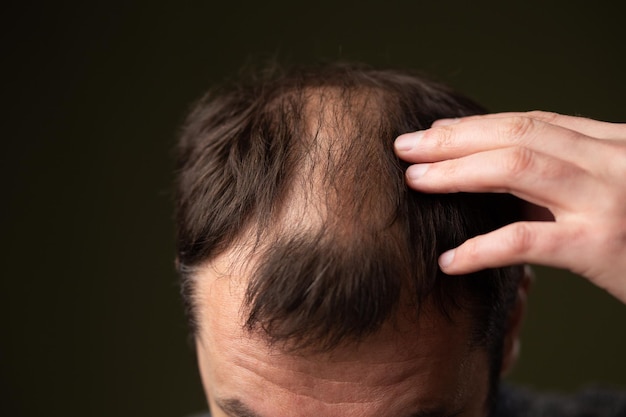 A man with baldness on a dark background head close-up.