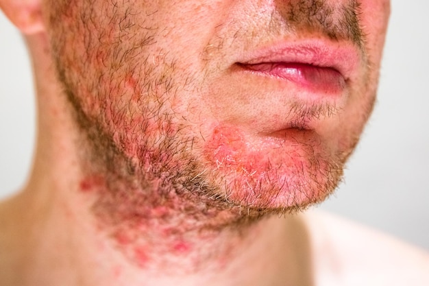 Photo man with seborrheic dermatitis in the beard area