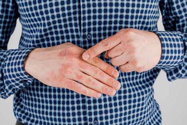 Man with sick hands dry flaky skin on his hand with vulgar psoriasis eczema and other skin diseases such as fungus plaque rash and blemishes Autoimmune genetic disease