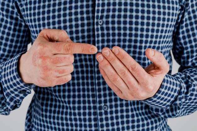 Man with sick hands dry flaky skin on his hand with vulgar psoriasis eczema and other skin diseases such as fungus plaque rash and blemishes Autoimmune genetic disease