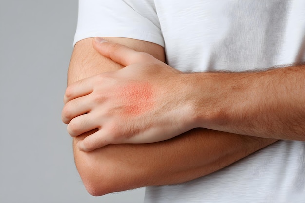 Man with skin diseases Red spot or rash of skin on womans hand Itchy hives Pele virus eczema