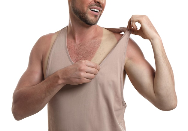 Man with sunburned skin on white background closeup