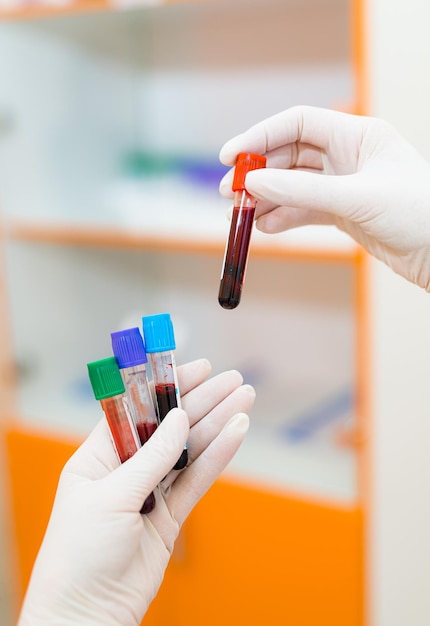 Medical equipment Blood test Technician holding blood tubes tests in the research laboratory