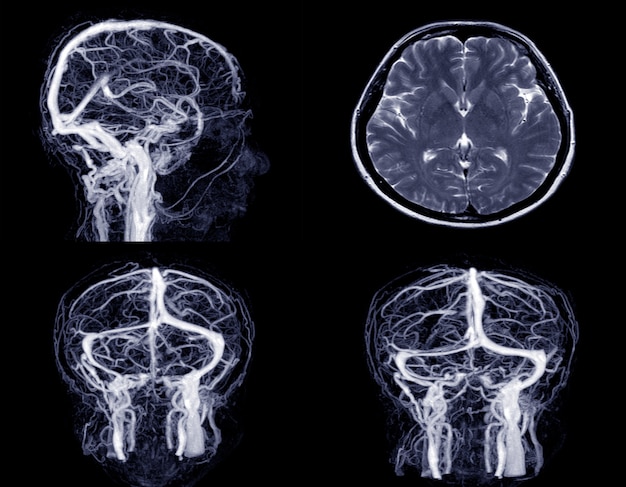 Medical image MRV (magnetic resonance venography) Brain of veins in human head.