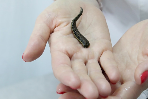 Medical leech on the doctor's gloved hand