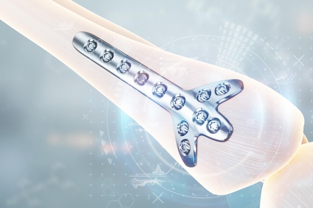 Medical procedure osteosynthesis operation surgical repositioning of leg bones Fixation of a broken bone with a metal plate technology fixation of a fracture 3D render 3D illustration