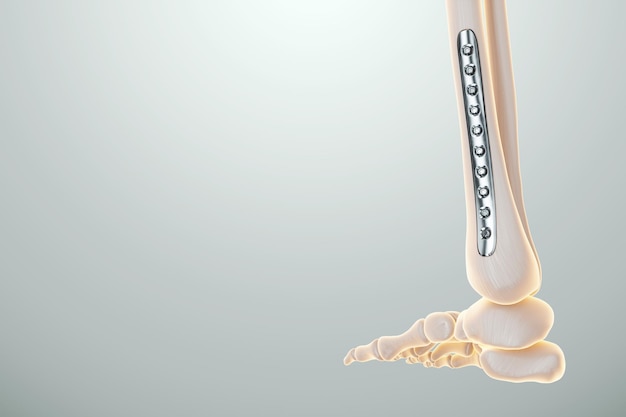 Medical procedure osteosynthesis operation surgical repositioning of leg bones Fixation of a broken bone with a metal plate technology fixation of a fracture 3D render 3D illustration