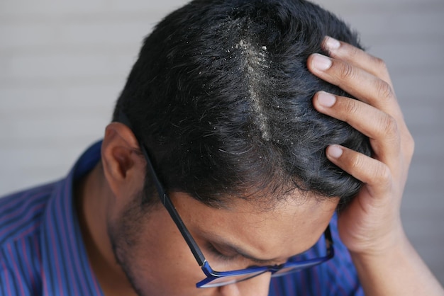 Men with dandruff in his hair closeup