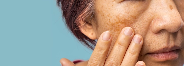 Menopausal women worry about melasma on face