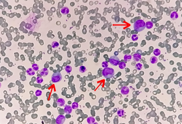 Microscopic 100x view of Chronic myelocytic leukemia or CML