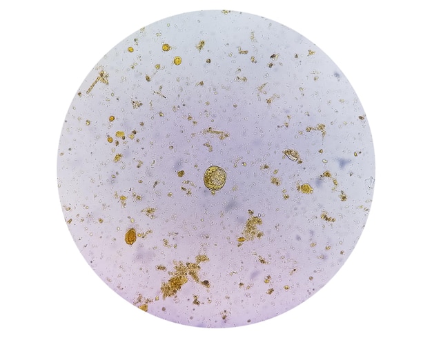 Microscopic examination of Stool showing Blastocystis hominis parasite.