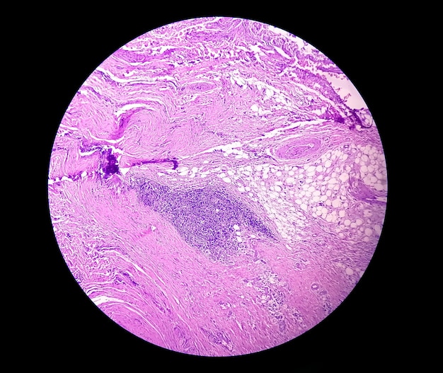 Microscopic examination of thyroglossal duct cyst. Persistent thyroglossal duct