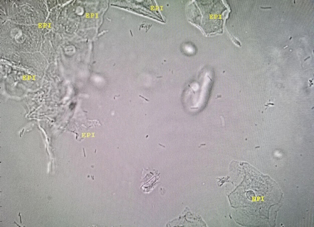 Microscopic image of abnormal urinalysis. urine exam. Urine routine examination.