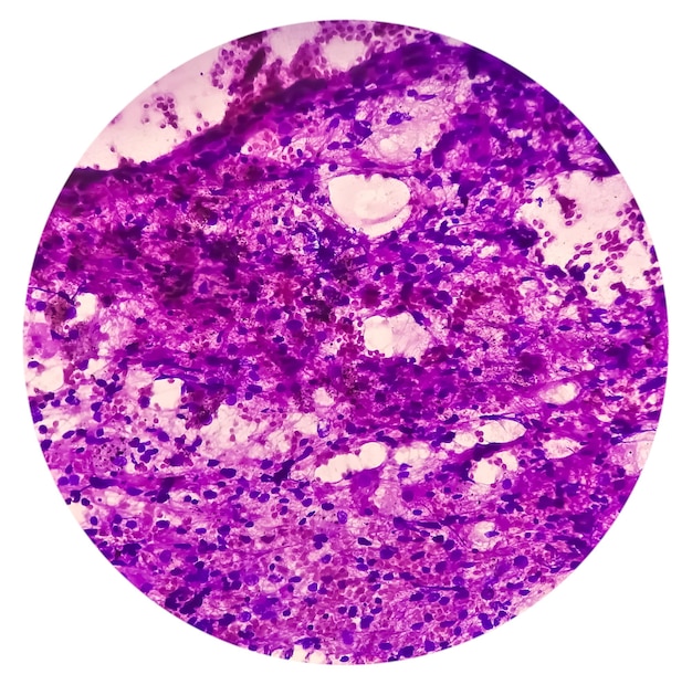 Microscopic image of small cell carcinoma of lung with 40x focus