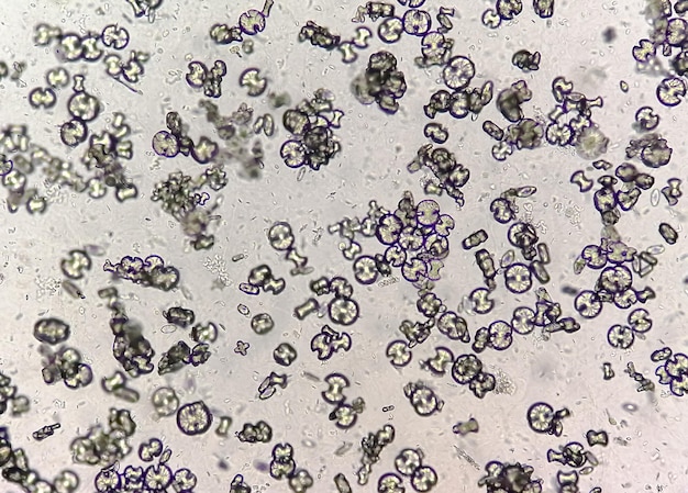 Microscopic Urinalysis showing calcium oxalate monohydrate, uric acid and triple phosphate crystal