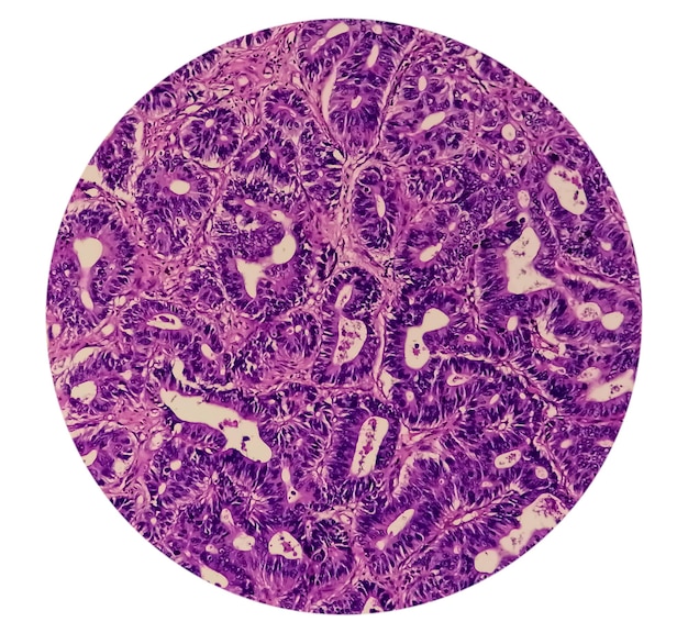 Microscopic view of Adenocarcinoma with a focus of 40x