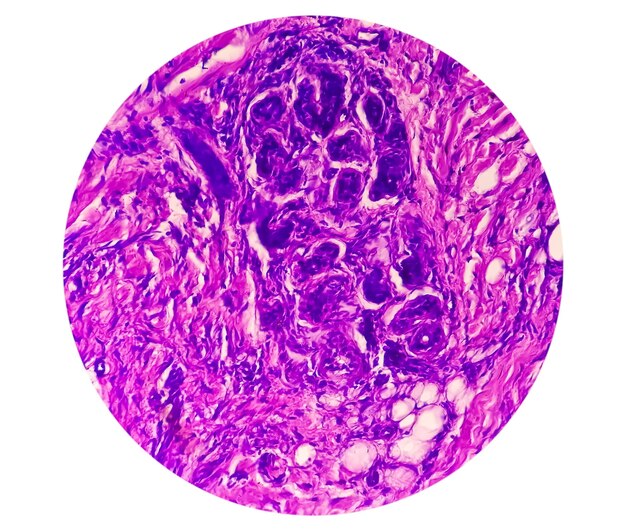 Photo microscopic view of basal cell carcinoma is a type of skin cancer