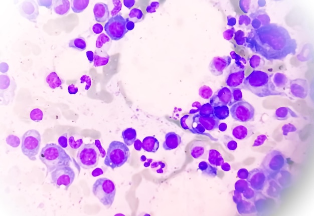 Microscopic view of bone marrow slide showing Multiple myeloma,  is a type of bone marrow cancer.