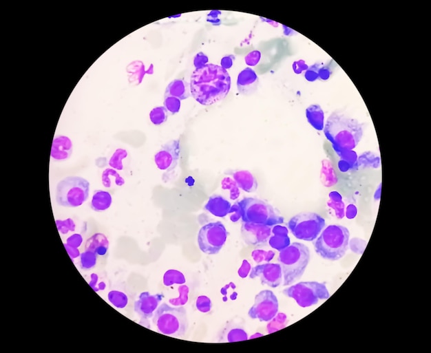 Microscopic view of bone marrow slide showing Multiple myeloma, a type of bone marrow cancer.