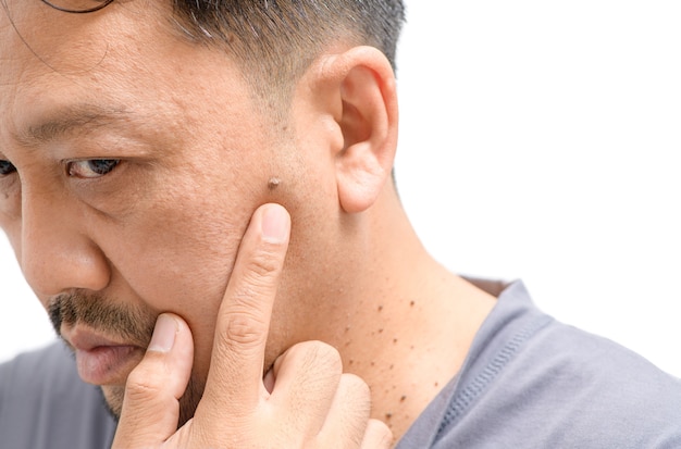 Middle-aged asian man worry about big skin tags or Acrochordon on face