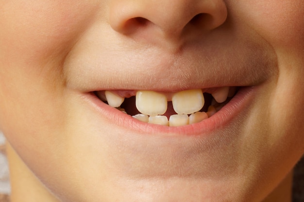 Milk teeth close-up, the child shows his changing teeth.