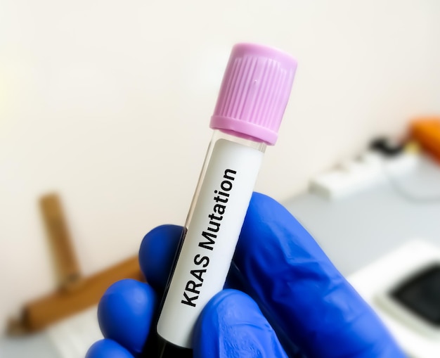 Molecular Biologist hold blood sample for  KRAS mutation test for lung cancer.