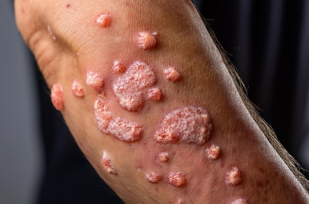 Monkeypox Virus on the skin Microscopic View of the Monkeypox Virus CloseUp Monkeypox