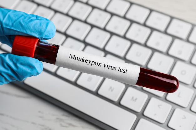 Monkeypox virus test Laboratory worker holding sample tube with blood over table closeup