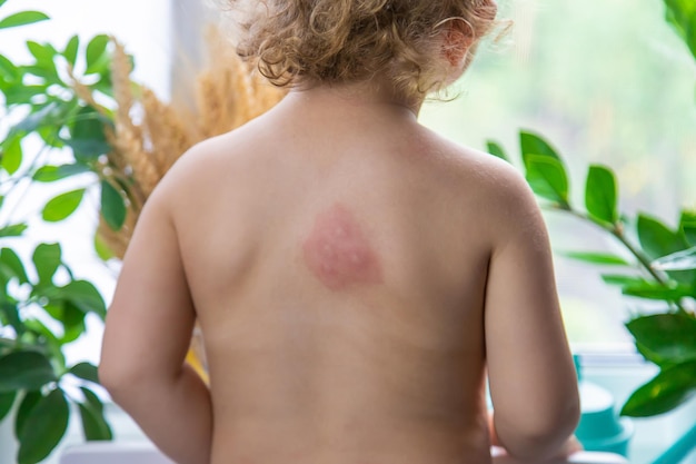 Mosquito bites on a child back Selective focus