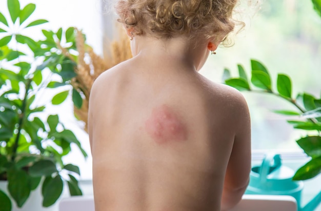 Mosquito bites on a child back Selective focus