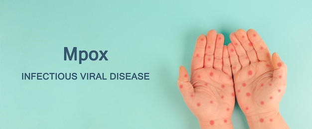 Photo mpox hands with monkeypox rash outbreak of the mpxv virus infectious viral disease spreading