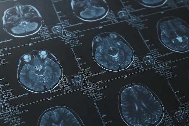 MRI or magnetic resonance imaging of the head and brain Close up