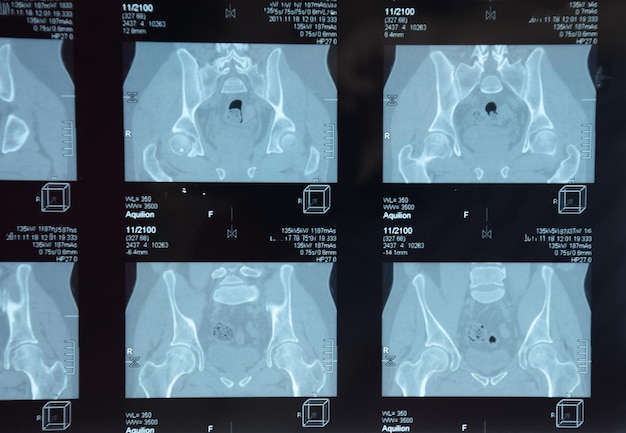 Photo mri sacroiliac articulation study of ankylosing spondyloarthritis patient