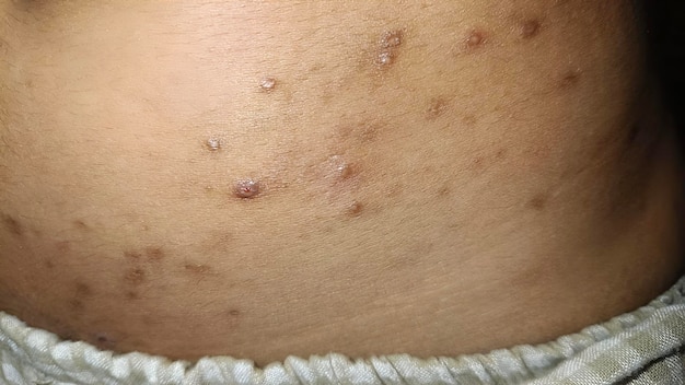 Photo multiple skin lesions including small bumps and dark spots on the abdomen