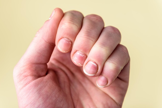 Nails with white spots on yellow background. Leukonychia, calcium deficit.