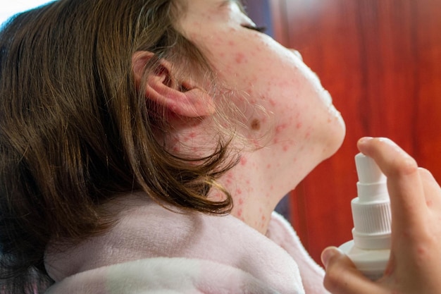 Natural vaccination. Contagious disease. Sick boy chickenpox with toy bear. Varicella virus or Chick