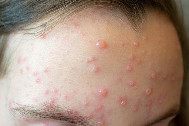 Natural vaccination. Contagious disease. Sick child with chickenpox. Varicella virus or Chickenpox b